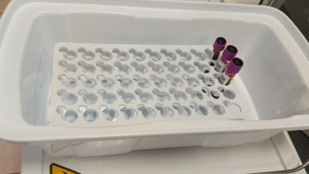 Фотография к новости: "Екінші өмір": Қазақстанда сүйек кемігін трансплантациялау қалай жасалады?