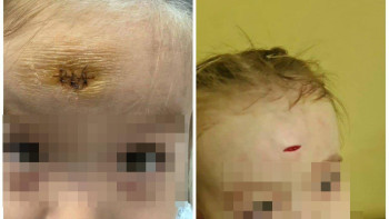 Фотография к новости: Алматыда балабақша тәрбиешісі баланың маңдайын жарып жіберген