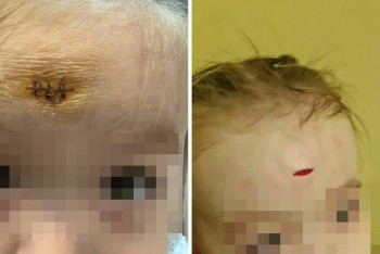 Фотография к новости: Алматыда балабақша тәрбиешісі баланың маңдайын жарып жіберген