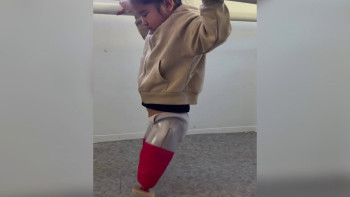 Фотография к новости: Автобус апаты: Екі аяғынан айырылған бүлдіршін протезбен жүруді үйренуде