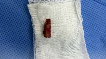 Фотография к новости: Дәрігерлер баланың басынан 5 жыл бұрын қадалған бұтақты алып шықты