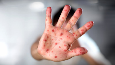 Астанада қызылша өршіп тұр: Балаларға қауіп бар