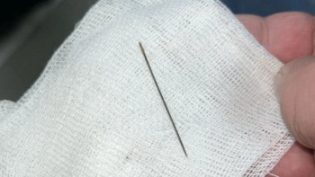 Фотография к новости: Түркістанда 8 айлық сәбидің ішінен ине табылды