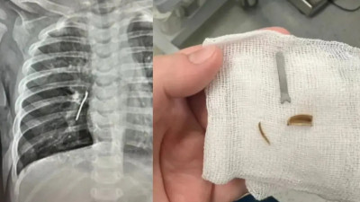 Ақтауда 11 айлық сәбидің өкпесінен шемішкенің қабығы мен темір табылды