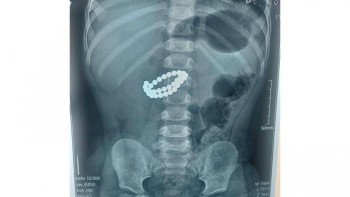 Фотография к новости: Алматыда 31 магнит жұтып қойған бір жасар балаға шұғыл ота жасалды