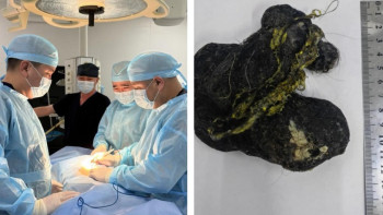 Фотография к новости: Асқазаннан шыққан шаш: Шымкентте 8 жасар балаға шұғыл ота жасалды