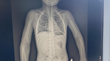 Фотография к новости: Көкшетауда стоматологияда 3 жасар қыз медициналық құралды жұтып қойды