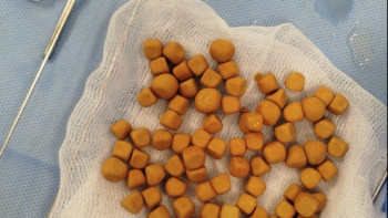 Фотография к новости: Түркістанда науқастың қуығынан 80-ге жуық тас алынды