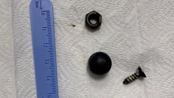 Фотография к новости: Шымкентте дәрігерлер баланың ішегінен магнит пен металл заттарды алып шықты