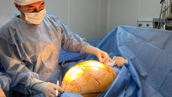 Фотография к новости: «Өзім емделемін» деген келіншектің ісігі 25 келіге жеткен: Дәрігерлер бірегей ота жасады