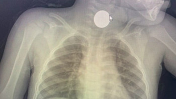 Фотография к новости: Жамбыл облысында дәрігер 3 жасар баланың өңешінен 100 теңгені алып шықты