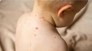 Фотография к новости: Бангладеште қызылша өршіп, бір айда 100 бала көз жұмды