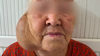 Фотография к новости: «Тыныс алу қиындады»: 10 жыл бойы алып ісікпен өмір сүрген қазақстандыққа ота жасалды