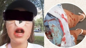 Фотография к новости: Жақ сүйегі сынып, екі тісі түсіп қалған: Қызды қағып, қашып кеткен электровелосипед жүргізушісі ұсталды