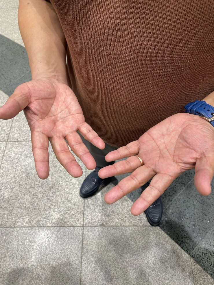 Әуежайда ерлік көрсеткен азамат оқиғадан кейін қолдарын көрсетті