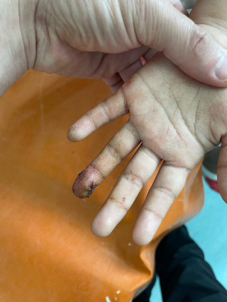 Саусағынан айырылған оқушының оқиғасына қатысты тергеу басталды