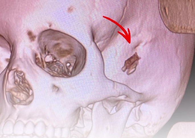 Дәрігерлер баланың басынан 5 жыл бұрын қадалған бұтақты алып шықты