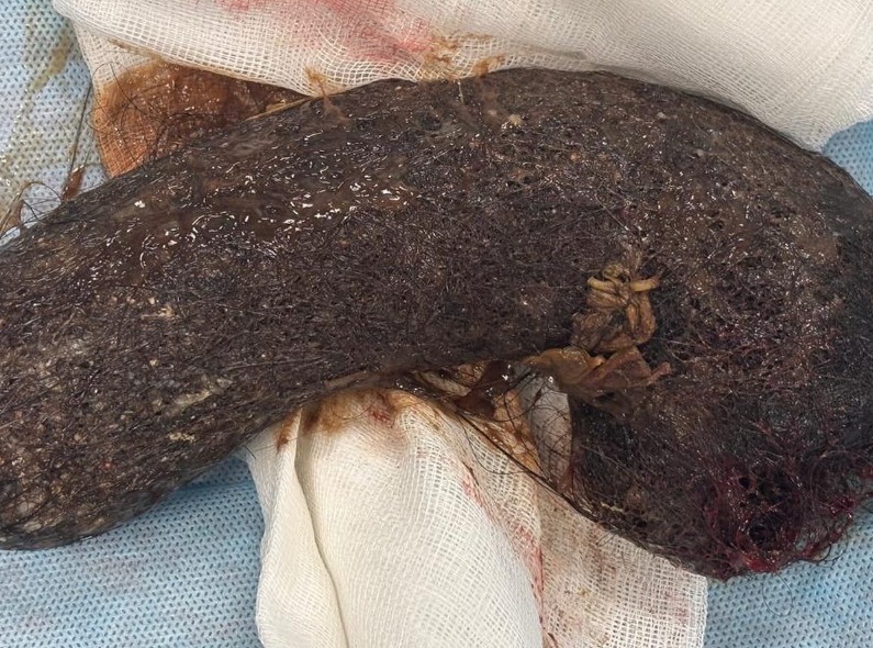 "Балалық әдет үлкен қауіпке айналды": Бойжеткеннің асқазанынан жұдырықтай шаш түйіні алынды