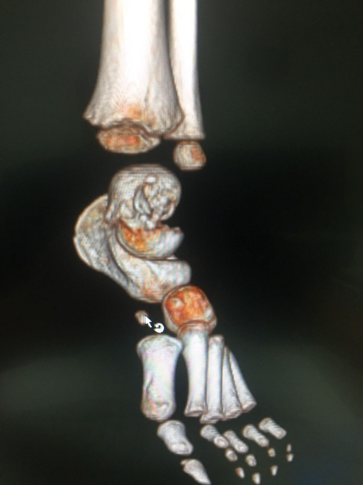 Қызылордалық дәрігерлер табанның күрделі патологиясын түзеді